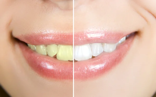 הלבנת שיניים – כל השיטות